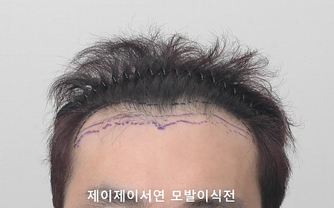 m자 탈모 