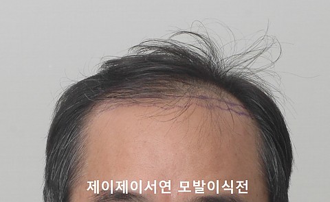 모발이식 