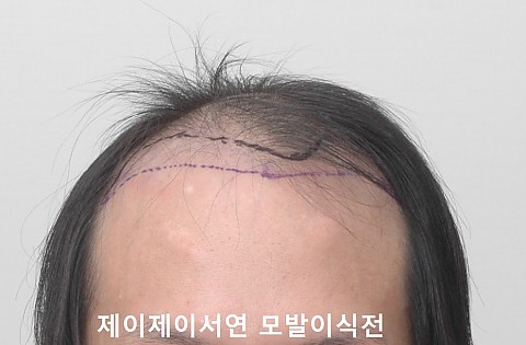 모발이식 전후 