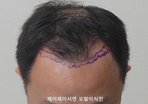 모발이식 경과 