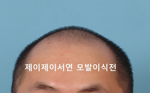 모발이식 