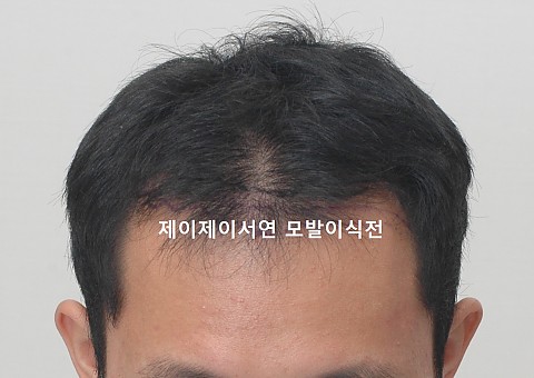 엠자 탈모 이식경과 