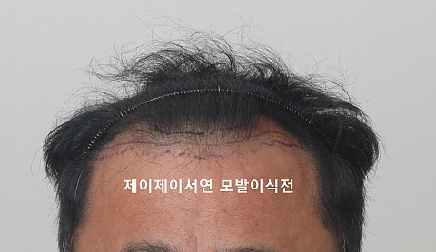 엠자탈모와 정수리탈모 동반시 모발이식 경과 