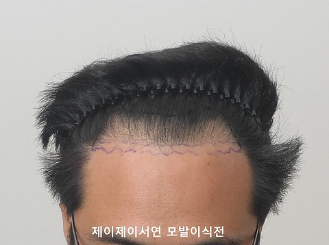 엠자 모발이식 