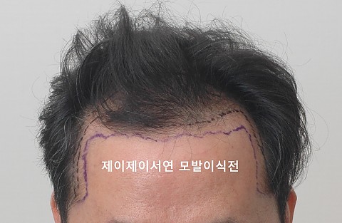 3500모 모발이식후 