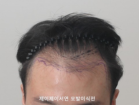 모발이식 경과 