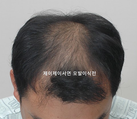 삭발 비절개 모발이식 경과 