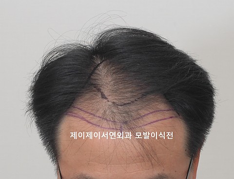 모발이식 4년경과 