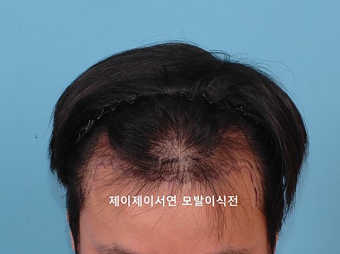 엠자탈모 모발이식후 6년 6개월후 
