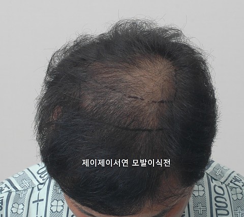 모발이식 경과 