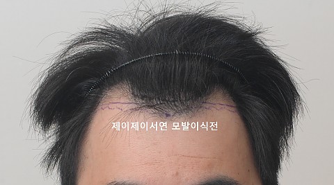 엠자 모발이식 경과 