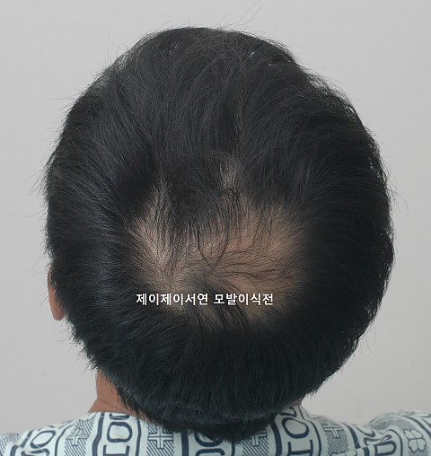 모발이식전 프로페시아 2년간 복용후 호전되지 않는 부위의 정수리모발이식 
