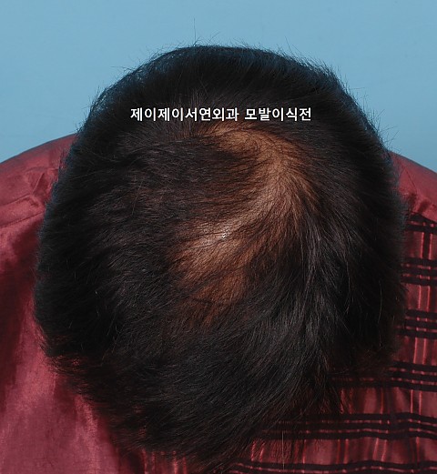 정수리탈모 이식후 6년1개월 경과 