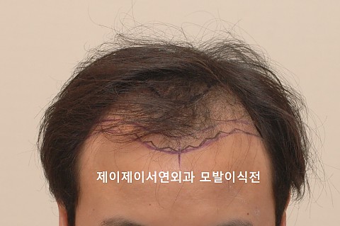모발이식 경과 