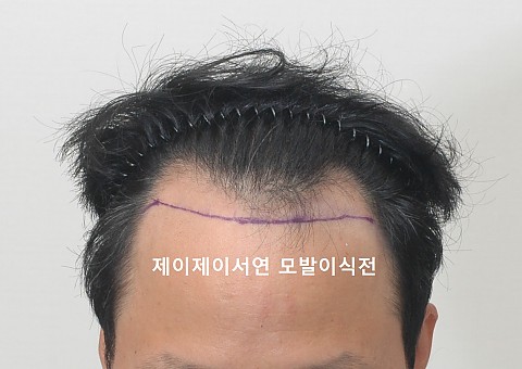 3500모 이식후 3년 