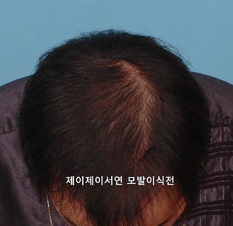 엠자탈모 정수리탈모 5000모 이식후 5년6개월후 