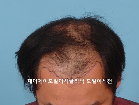모발이식후 5년 8개월 
