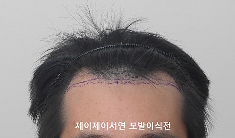 엠자 3000모 모발이식 경과 
