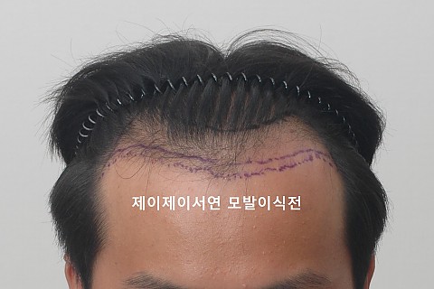 모발이식후 2주 6개월 