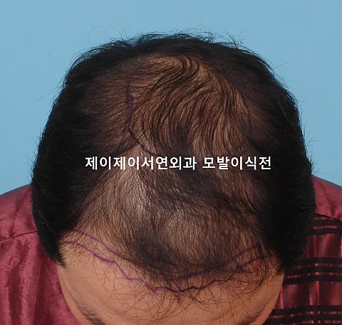 정수리탈모 