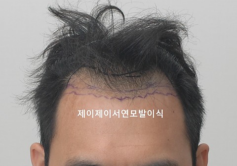 모발이식 1년7개월 