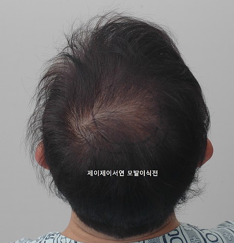 탈모약복용 2년 이상후 정수리 모발이식 