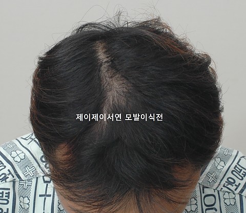 엠자와 정수리탈모 