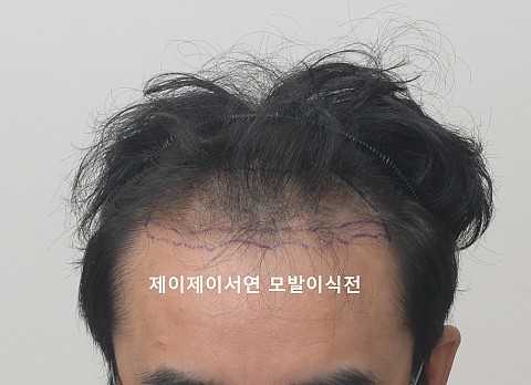 모발이식 