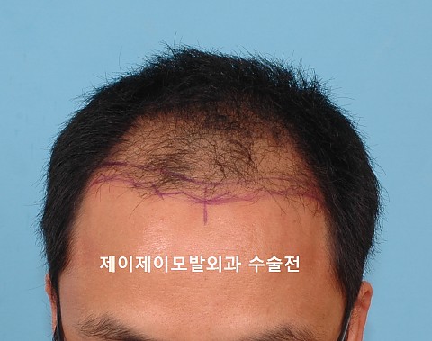 모발이식 