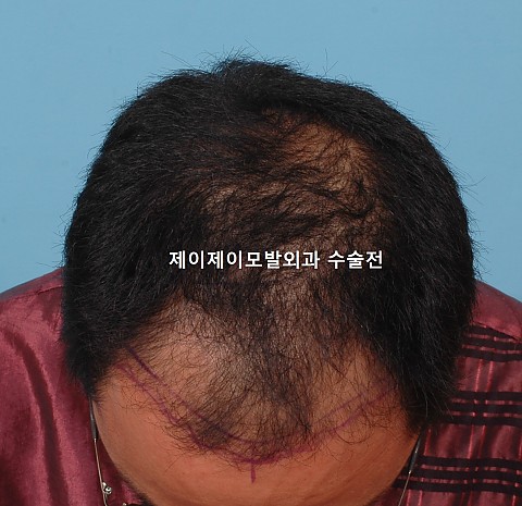 모발이식 