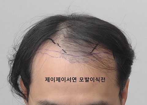 모발이식후 3년 