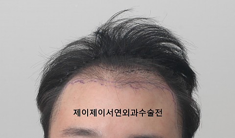 모발이식후 경과 