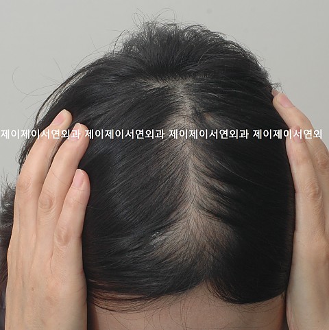 여성형 탈모 메조치료후 10개월 