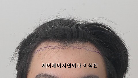 엠자 탈모 이식후 11개얼 
