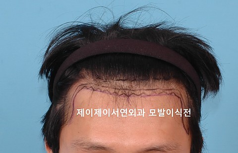 모발이식 6년6개월후 
