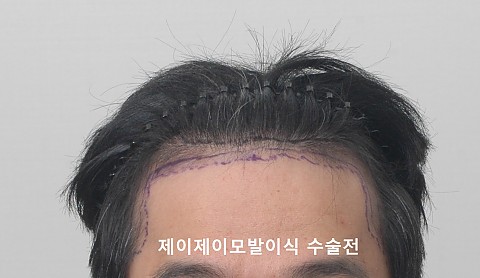 3500모 이식 전후 