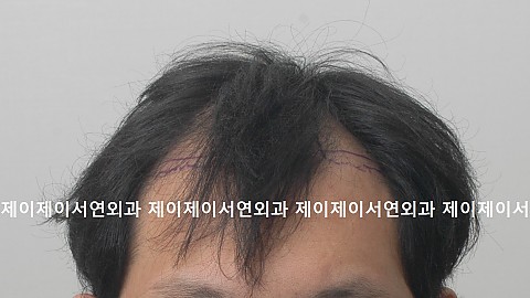 m+o 형 탈모 모발이식 