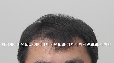 절개법 모발이식전후 다음날 2주 2년후 