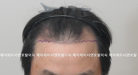 엠자 비절개모발이식후 직후 후두부 2주 경과 7개월후 경과 