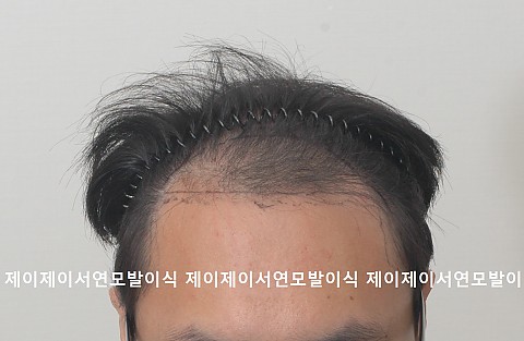 엠자 정수리탈모 4500모 절개법 모발이식후 수술 다음날 2주후 7개월후 경과 