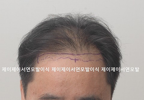 엠자 정수리 모발이식후 6개월 