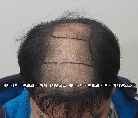 4500모 이식후 1년3개월후 