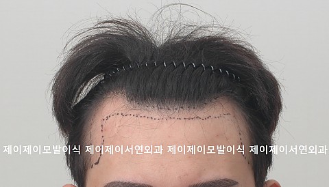 m자 탈모 3500모 절개모낭채취 식모기이식  순서대로 이식전.이식직후,이식후 4일 ,이식후 14일, 8개월 경과 