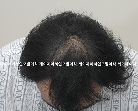 엠자 정수리 탈모 이식후 4년2개월 잘 유지됨 