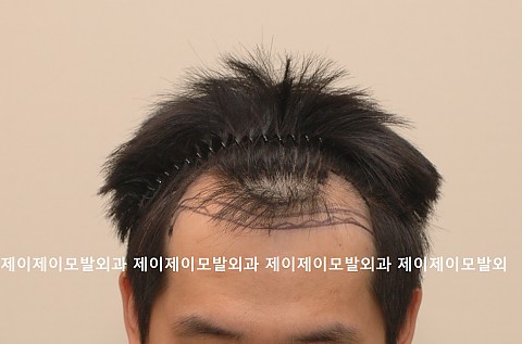 M자 탈모 모발이식 
