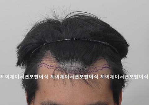 엠자탈모 3000모 모발이식후 