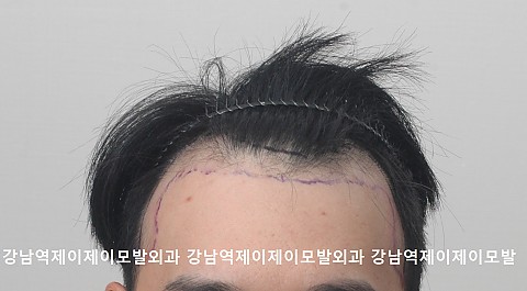 m자 탈모 4000모 모발이식후 4개월 15일 경과 