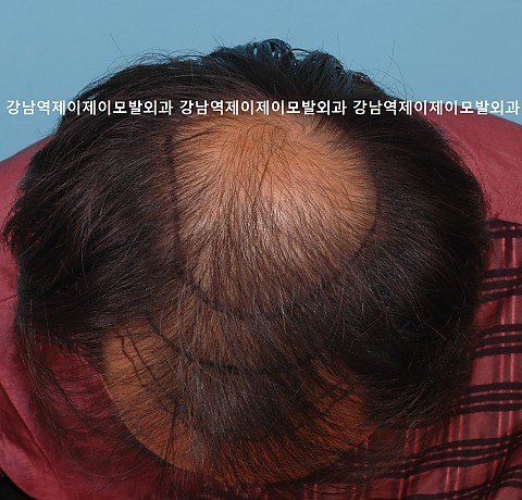 모발이식 7년 경과 
