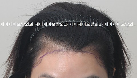헤어라인 모발이식 6개월 경과 