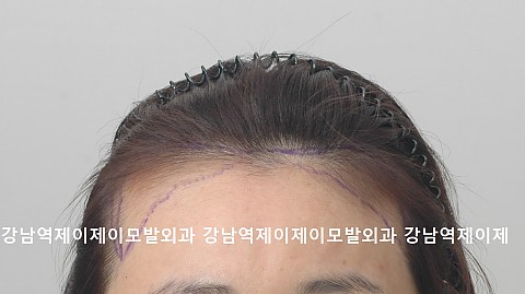 헤어라인교정 수술전 직후 2주후 5개월후 